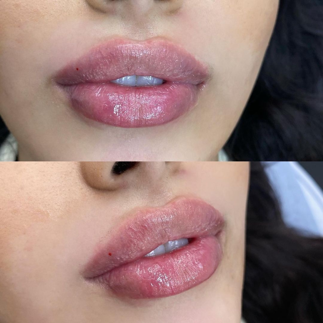 Lip Filler Half A Syringe at Blossoms HTX Hair Studio in Spring, TX