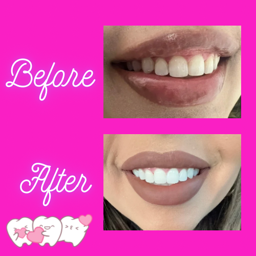 Teeth Whitening