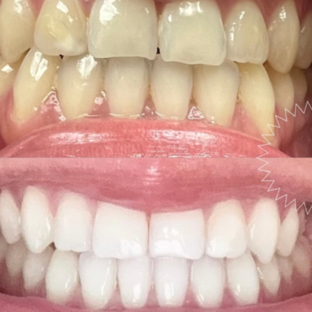 Teeth Whitening at GeMS Pearly Whites in Diboll, TX