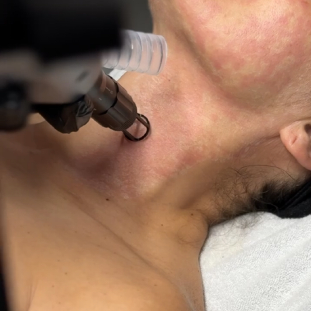 Neck SKIN TIGHTEN / RESURFACE at BEAUTY LAB COLLECTIVE in Miami, FL