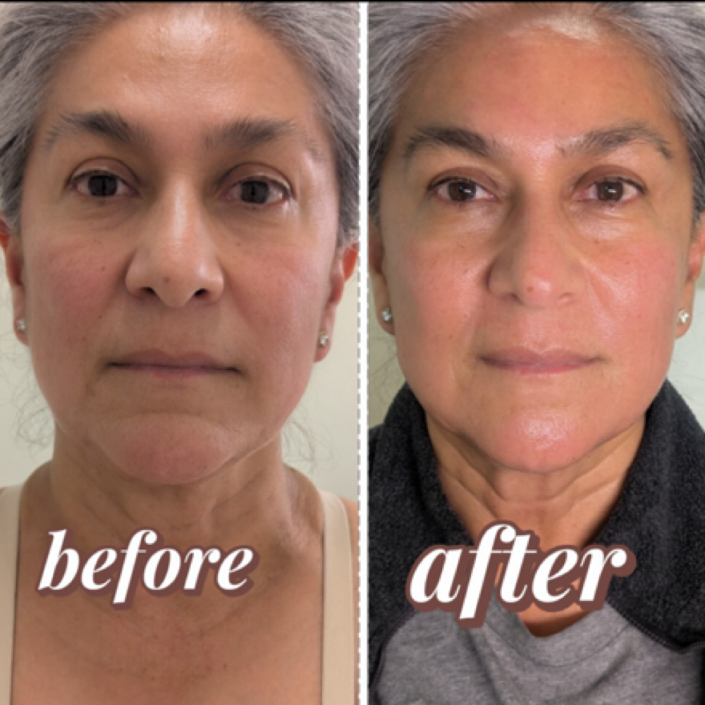 PDRN of Salmon Treatment at Nenusk Aesthetics in Long Island City, NY