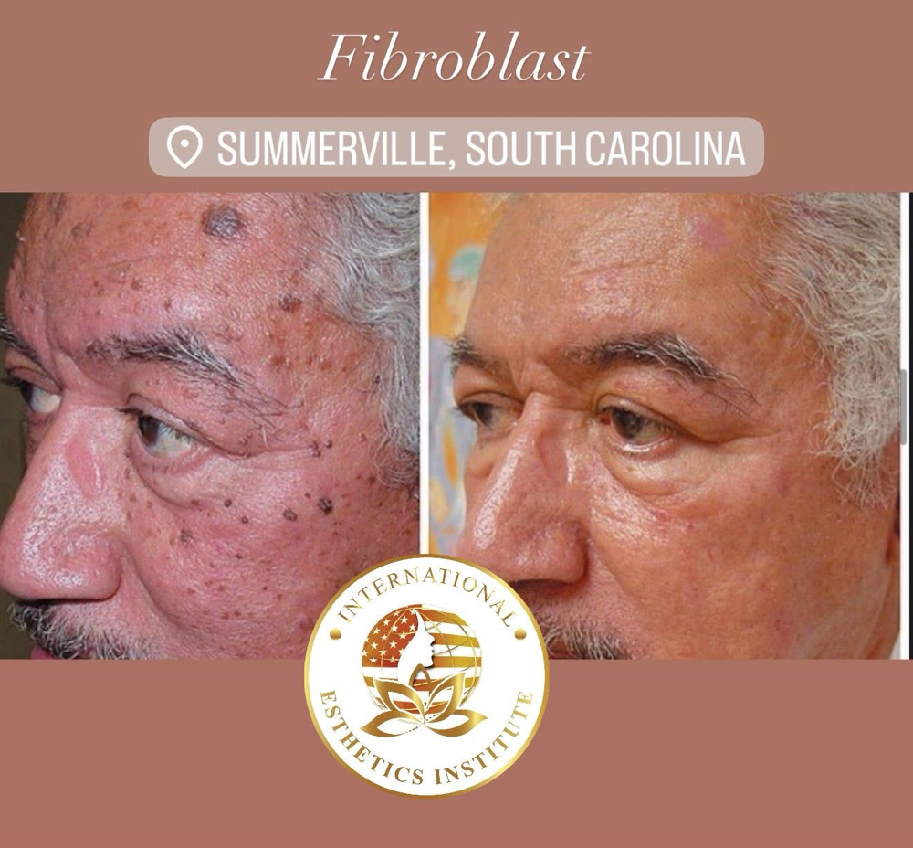 Fibroblast