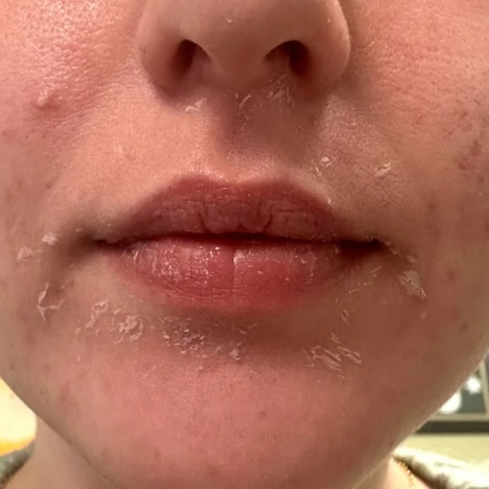 Perfection Peel at Andrea Godsey in Mesa, AZ