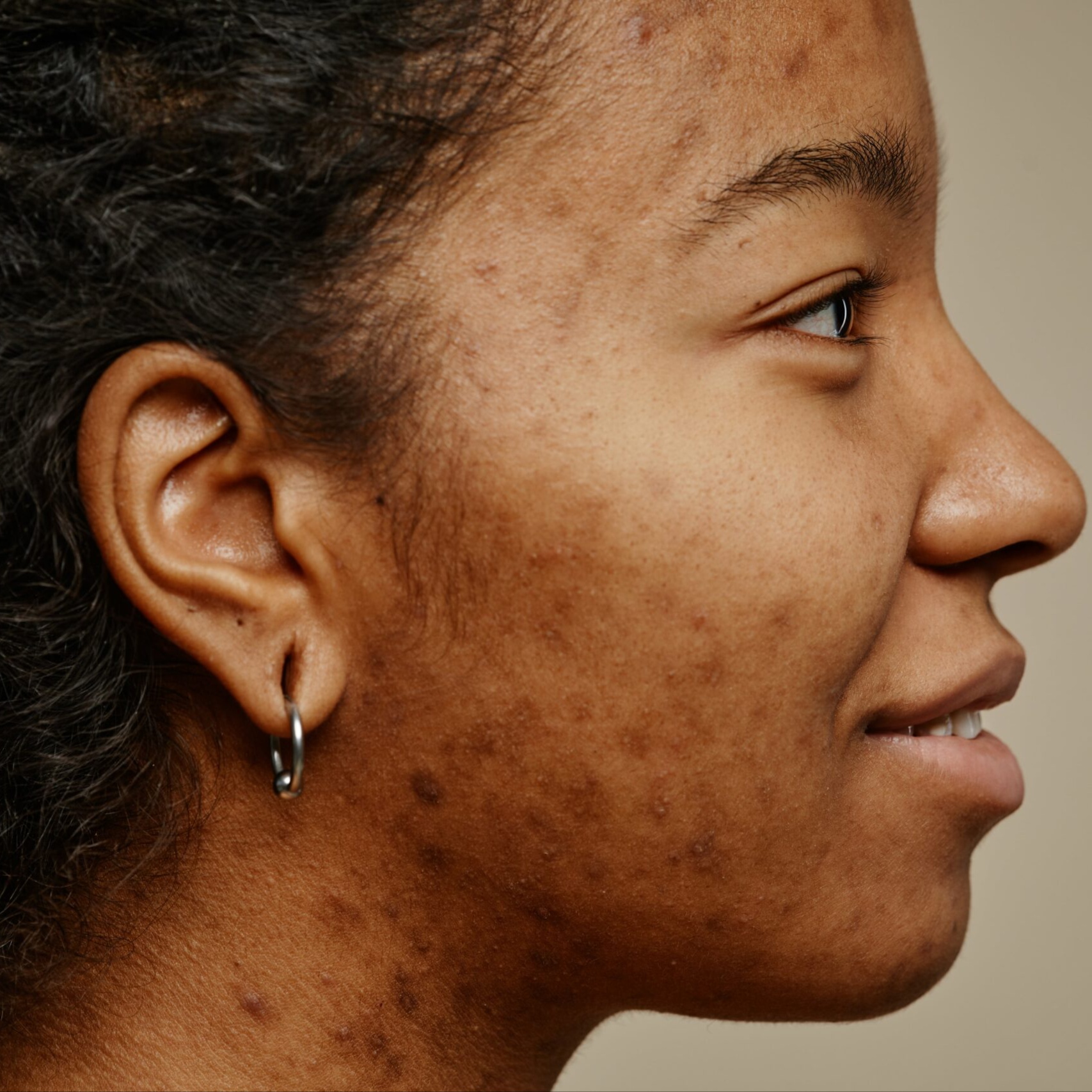 Hyperpigmentation facial at Spa Ravine Med Aesthetics in wayne, NJ