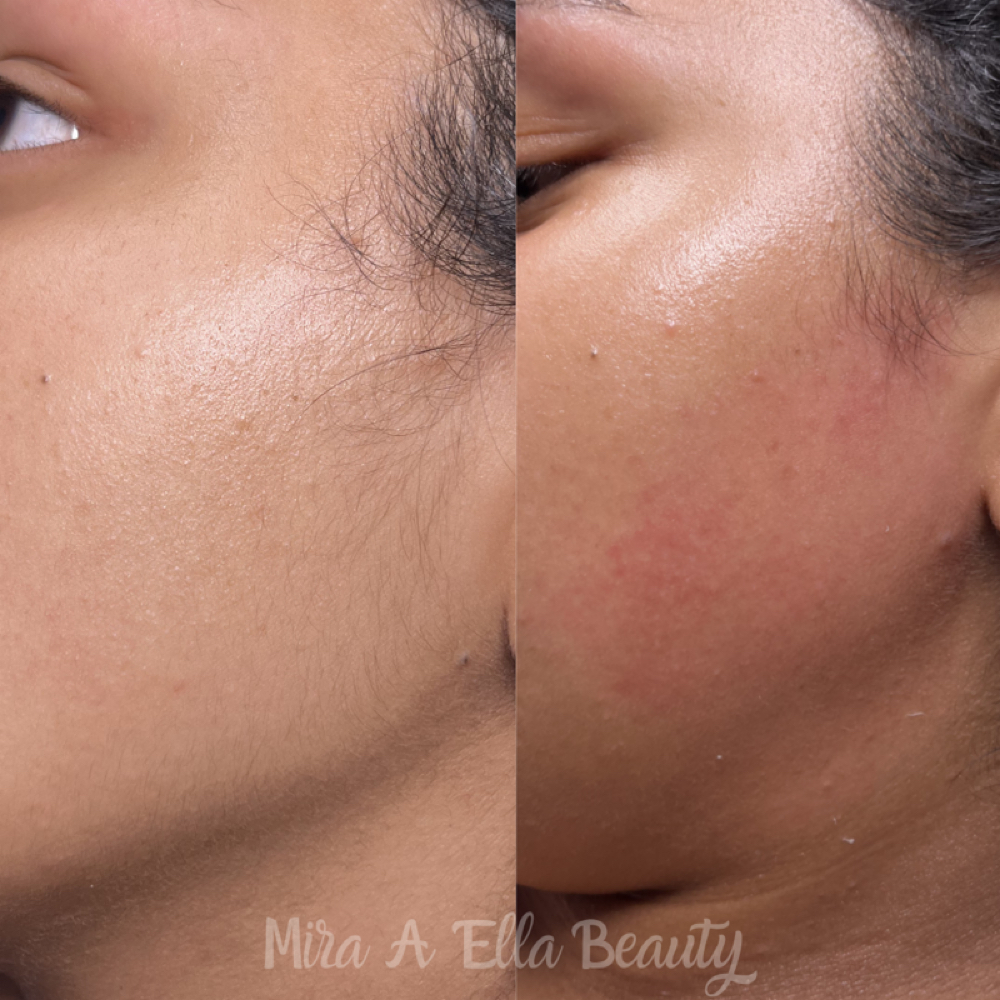 Beard, Cheek Or Sideburn Wax at JA Beauty & Skin in Kansas City, MO