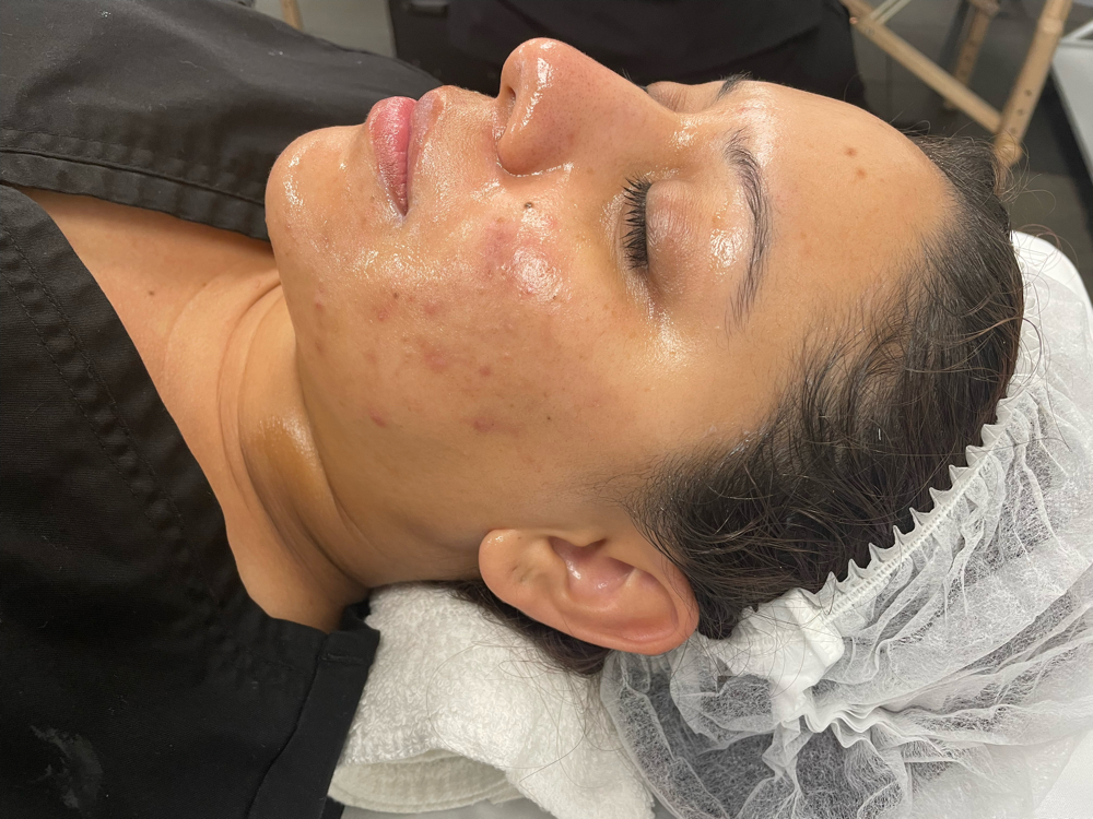 Acne Facial