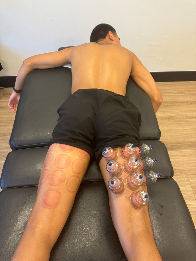 Cupping Therapy