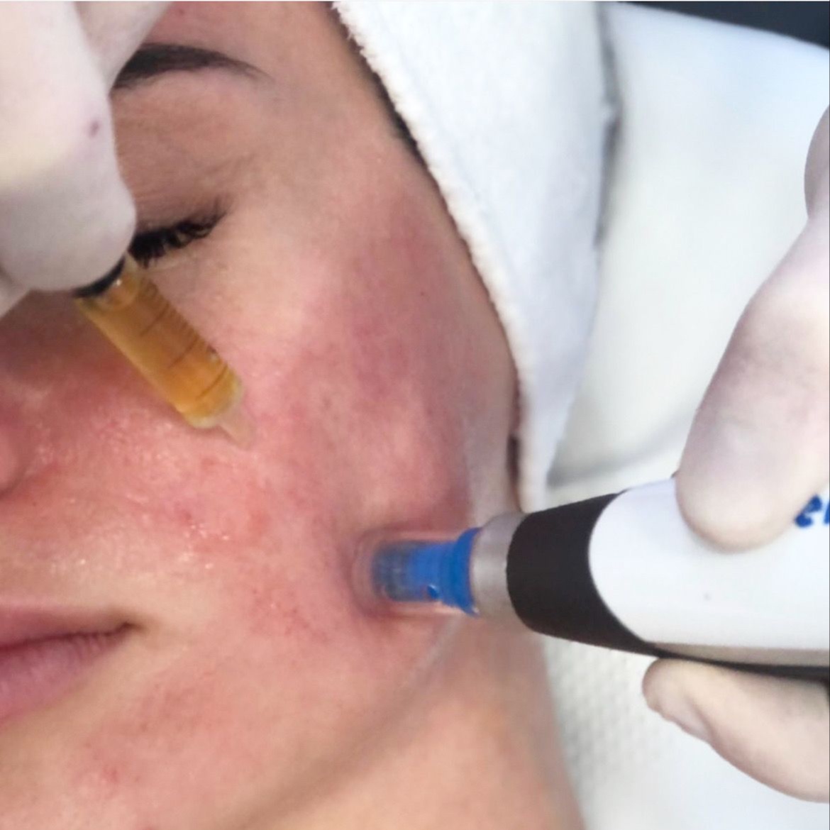 Micro-Needling at Luxe Beauty Bar & IV Hydration in Idabel, OK