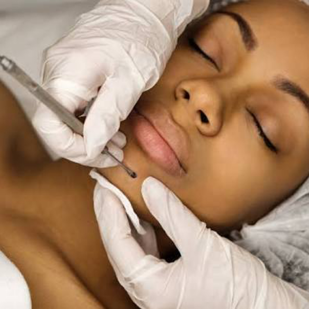 Deep Clean Facial W/extractions at Peachy Queen Waxing Lounge in Aurora, CO