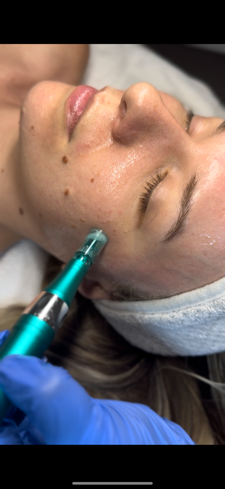 Microneedling