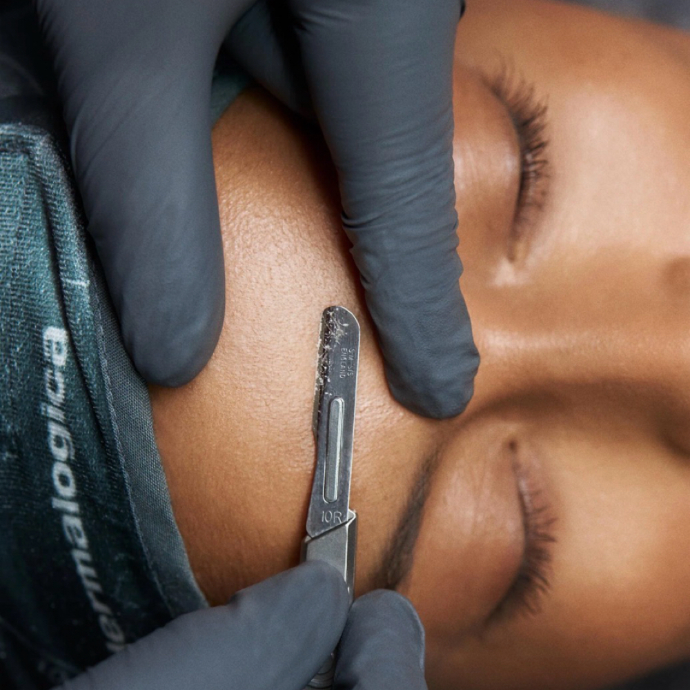 Dermaplaning at Colorado Beauty Bar in Aurora Colorado, CO