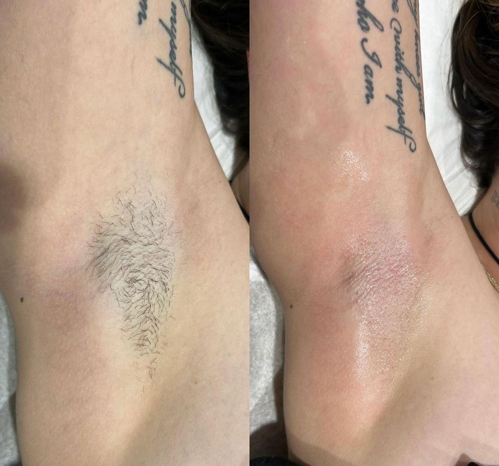 Underarm WAX