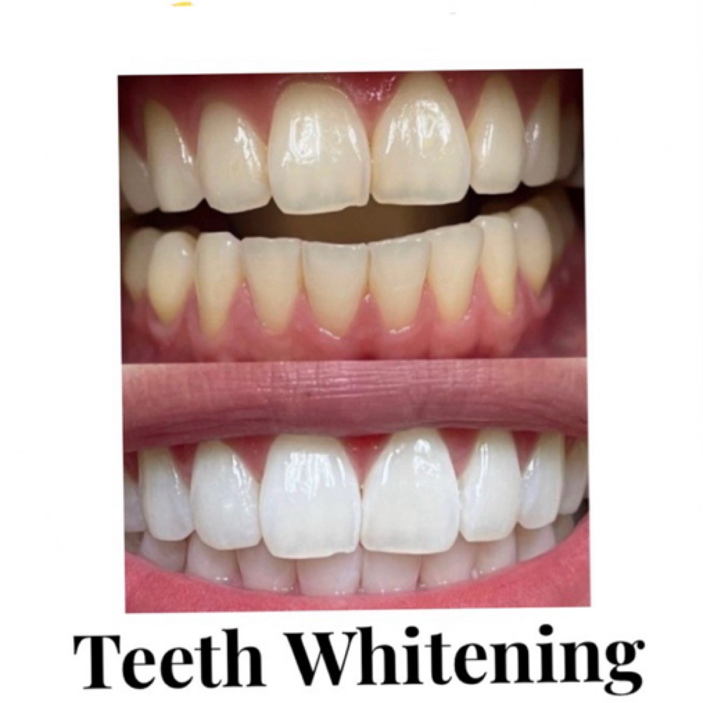 Professional Teeth Whitening🦷✨ at Envy Lash + Beauty in Hastings, MI