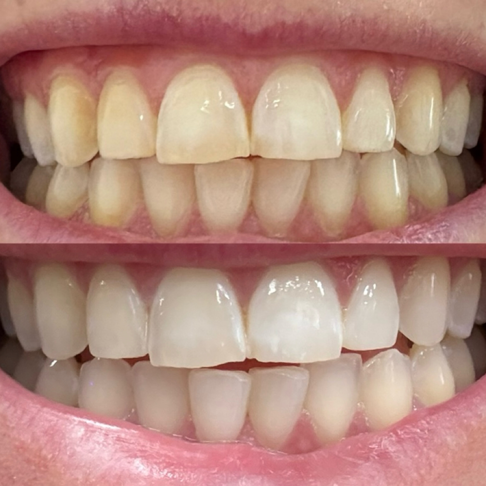 Professional Teeth Whitening🦷✨ at Envy Lash + Beauty in Hastings, MI