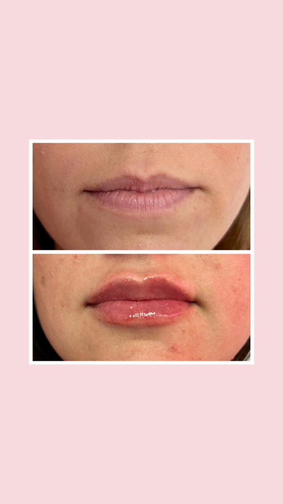 Lip Filler