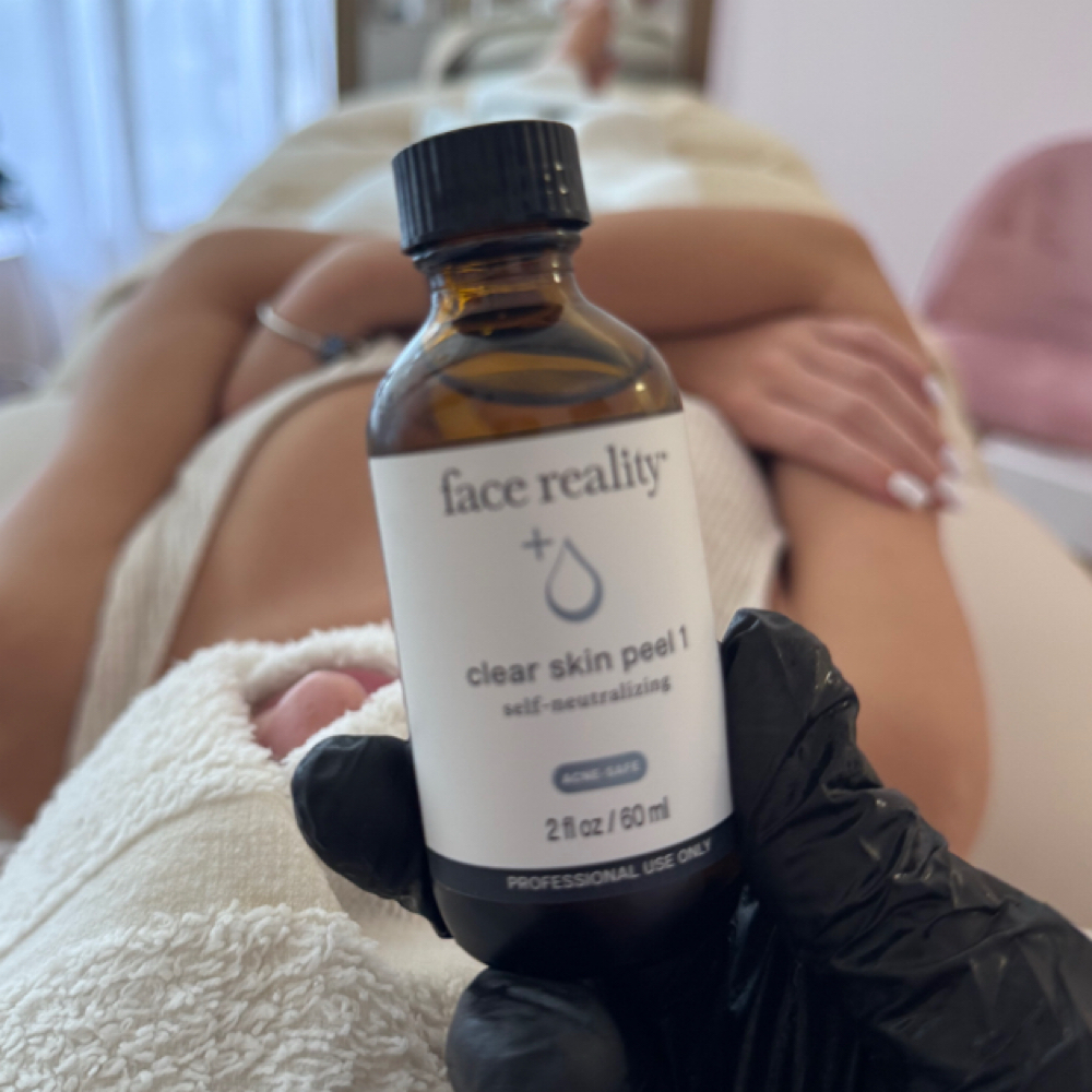 Face Reality Acne Peel at Skyn Esthetics INC. in Boca Raton, FL
