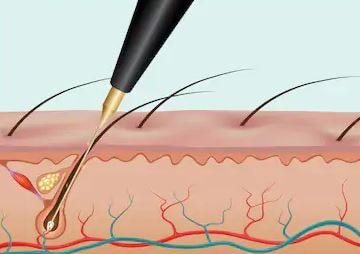 Electrolysis Consultation