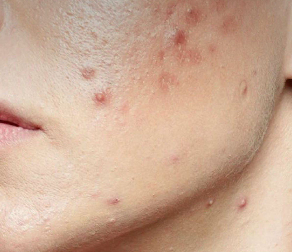 Serious Action Acne Facial
