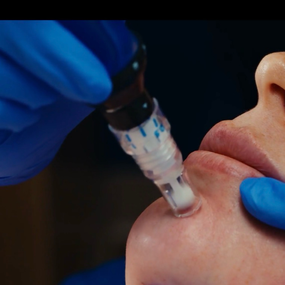 SkinPen Microneedling Treatment at Home Haven Aesthetics, LLC in Edinburg, TX