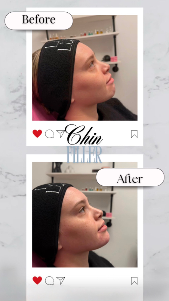Chin Augmentatiom