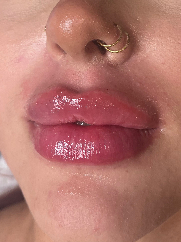 1ML• No Needle Lip Filler at The Glow Up By Jennifer in Austin, TX