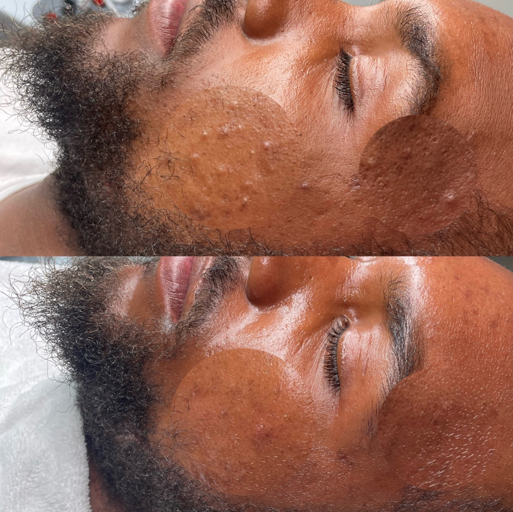 Gentlemens Facial & Beard Treatmet