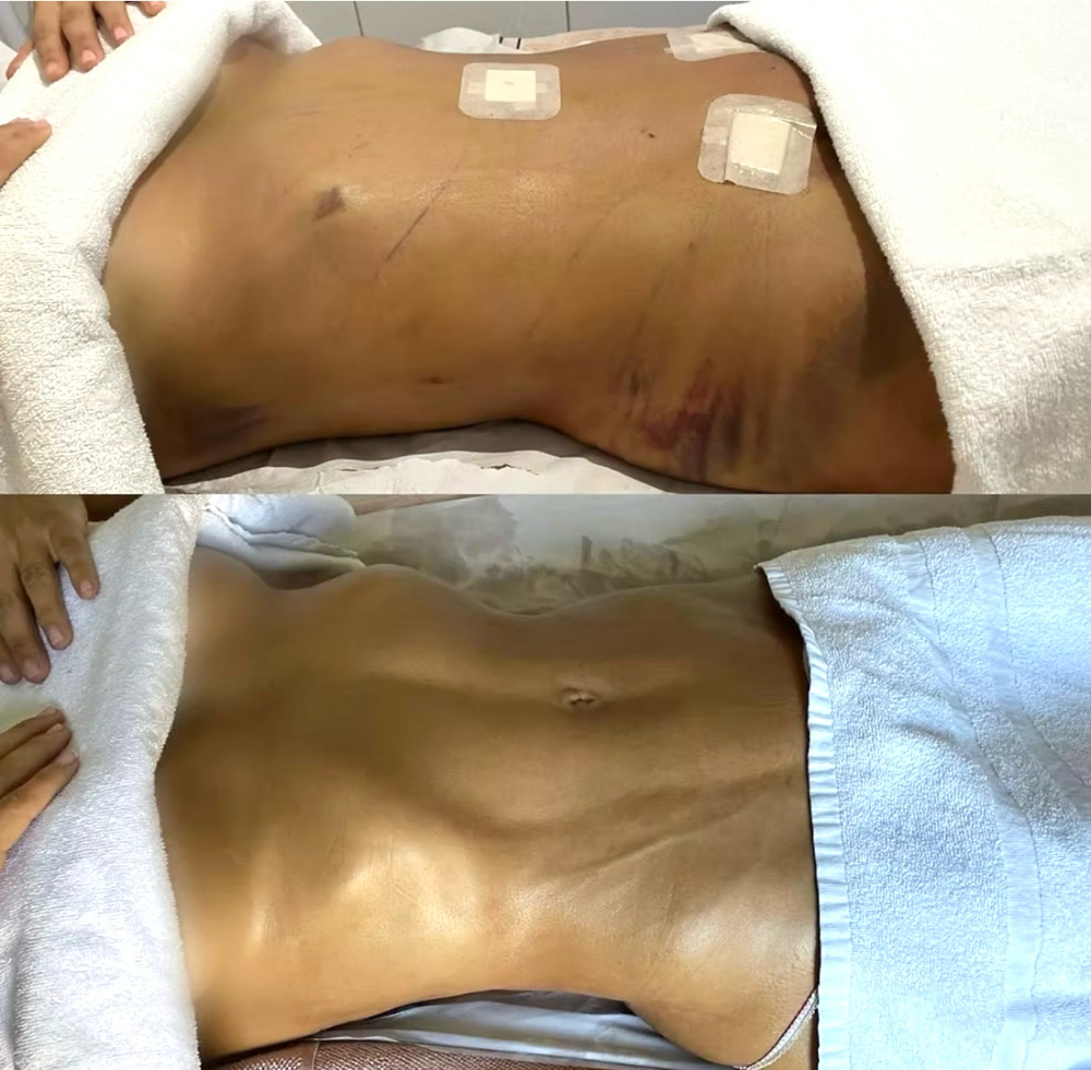 Post-Op 8 sessions pack💗