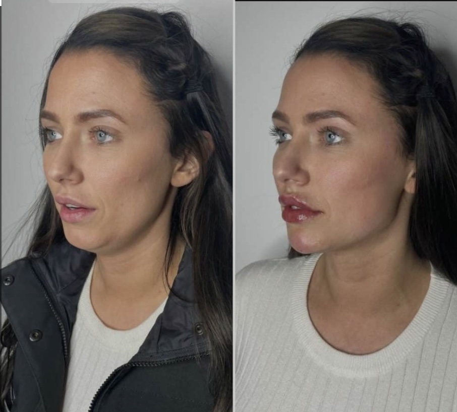 FullFacialBalance/armonización Com.