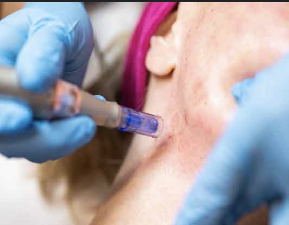 Neck MicroNeedling (add on)