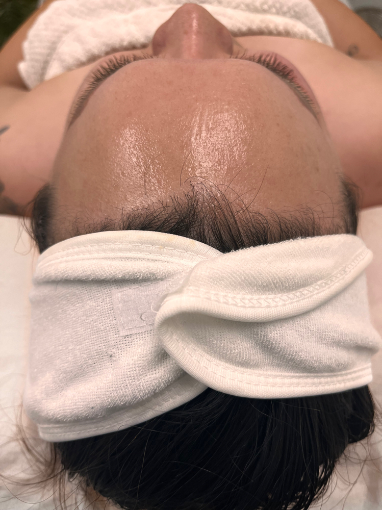 Micro-needling