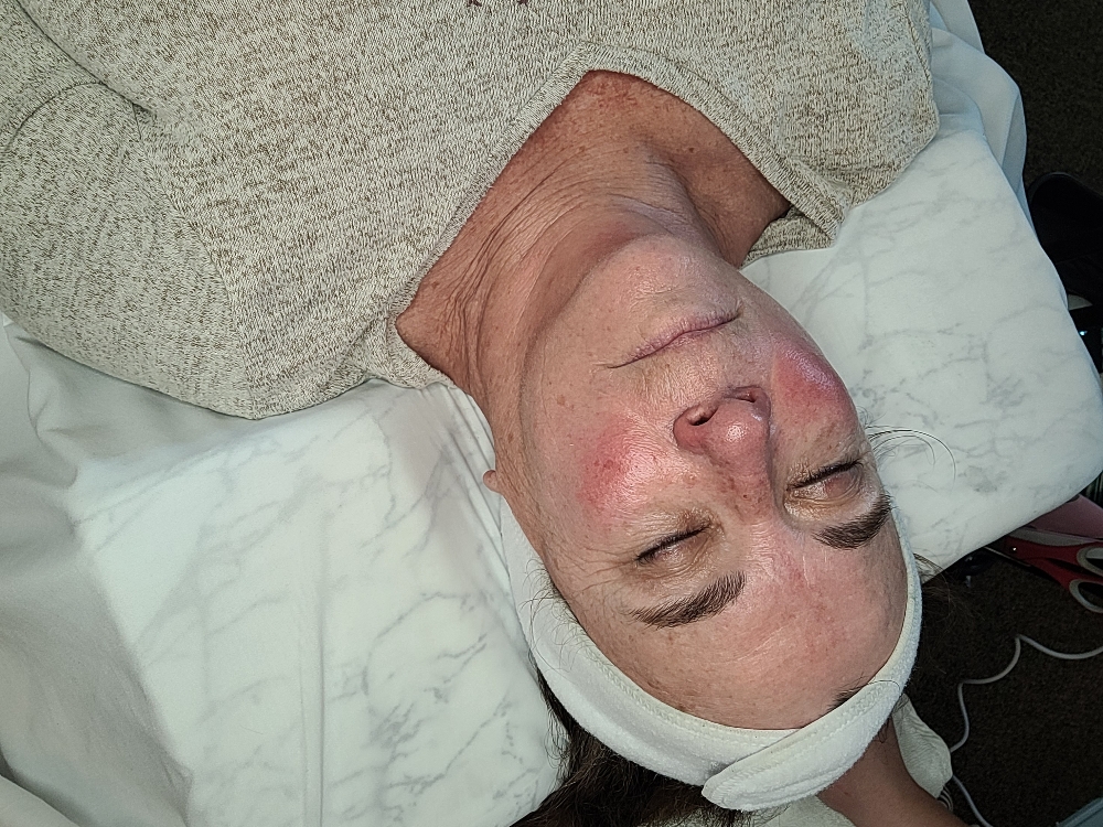 Dermaplane Facial