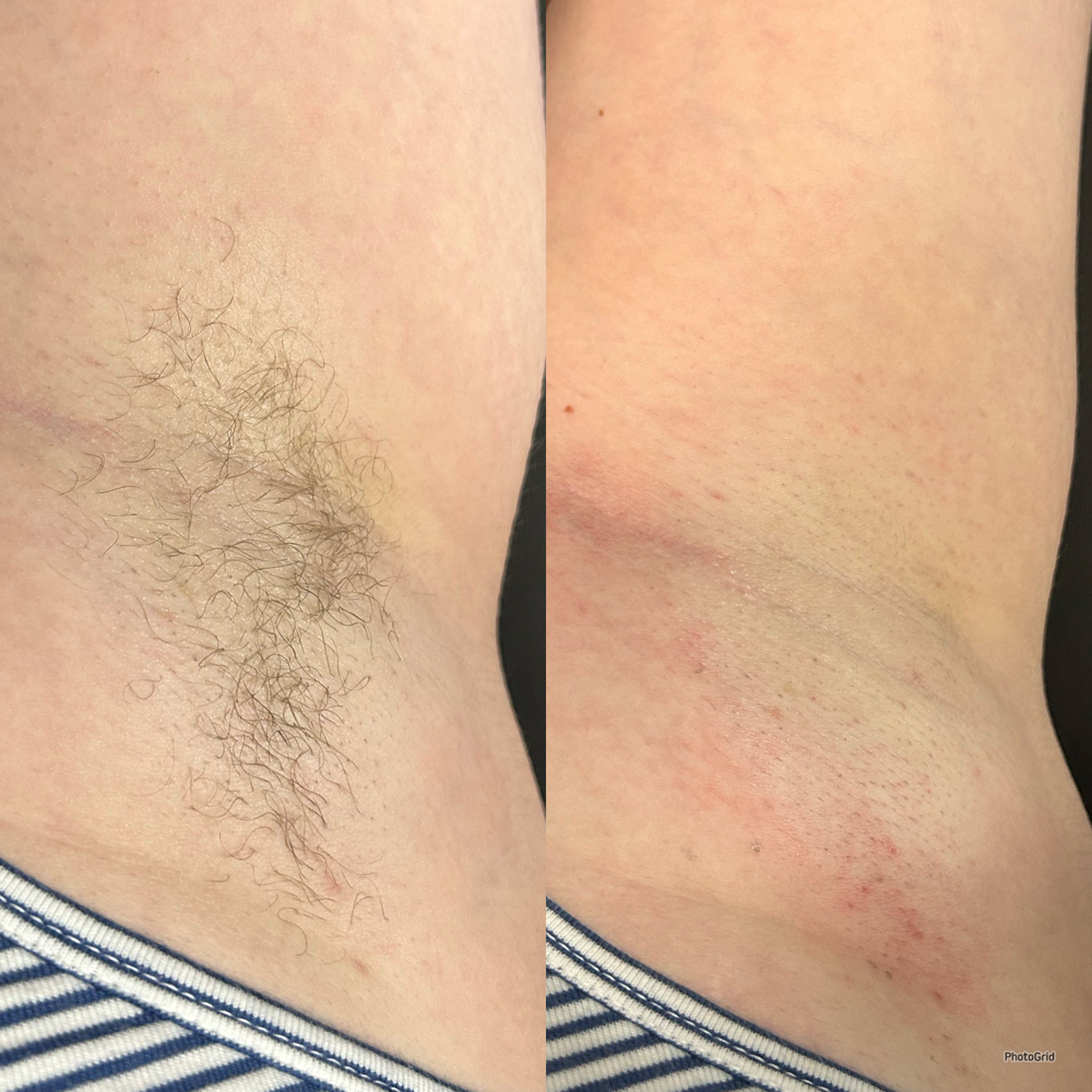 Underarm Wax at Golden Moon Esthetics, LLC in Frisco, TX