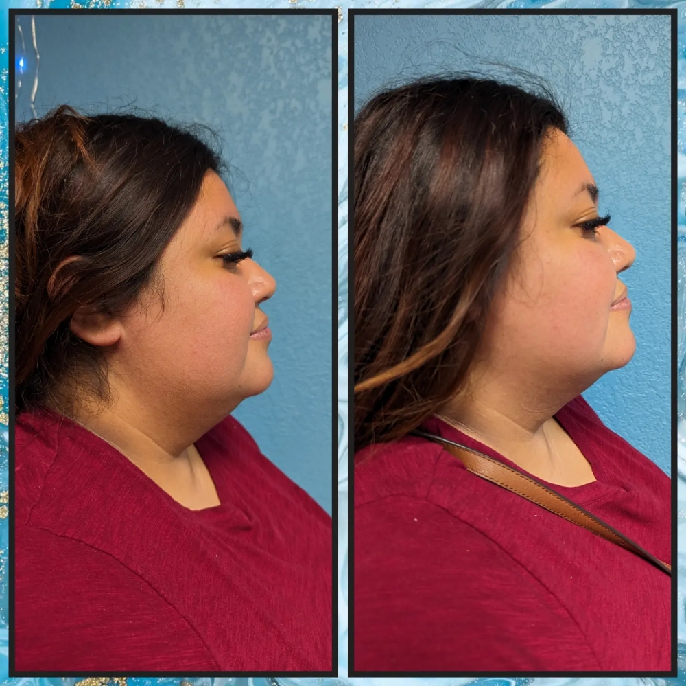 Chin Slimming