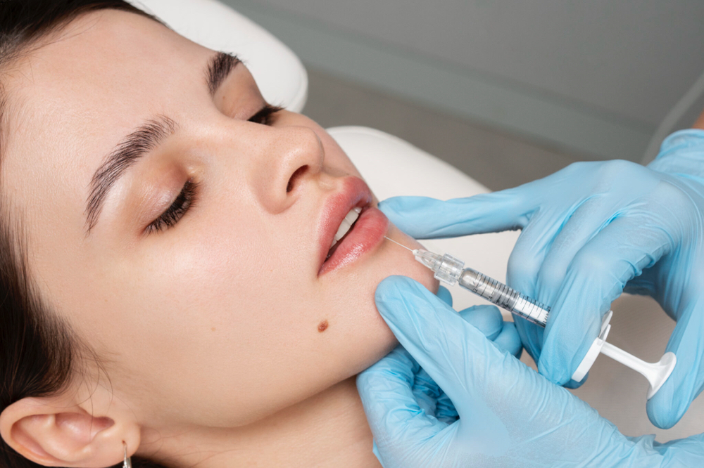 Juvederm Lip Filler 1 ml