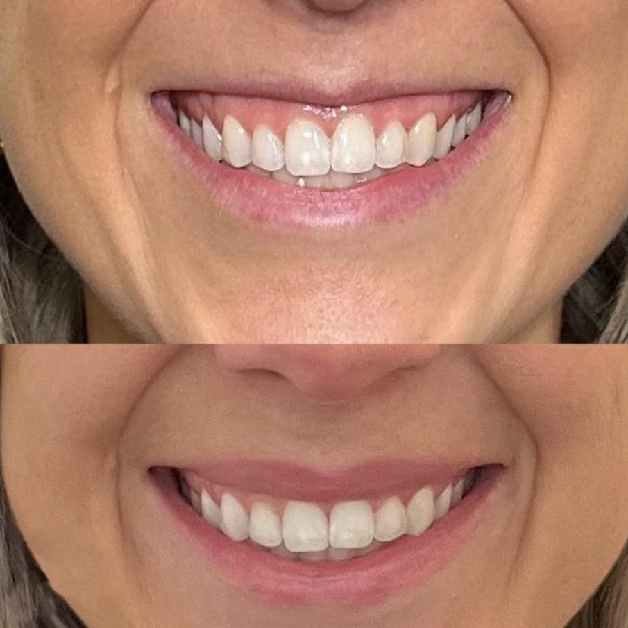 Lip Flip at TLN AESTHETICS MEDSPA in Lanham, MD