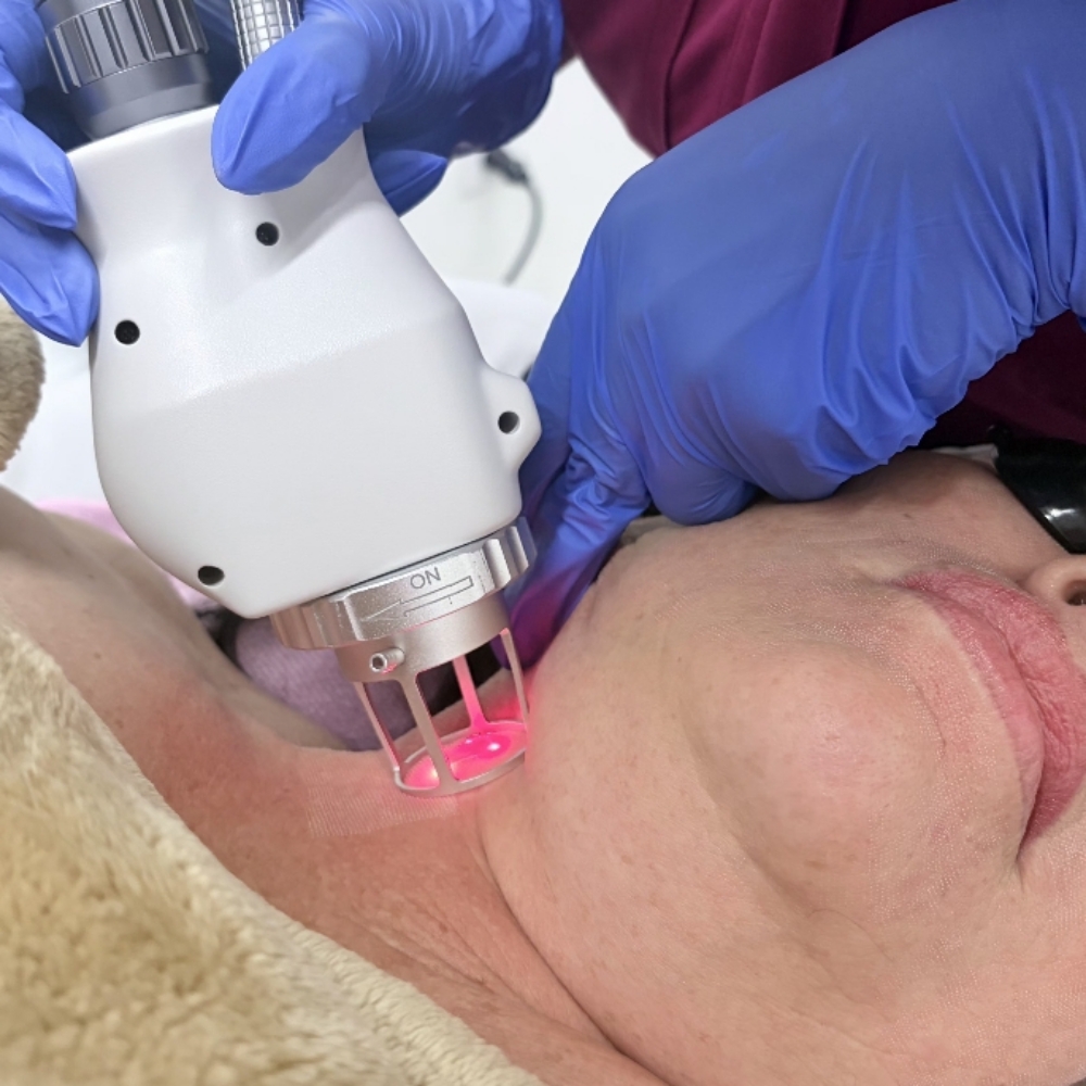 Co2 Neck Micropeel at Skin Commitment LLC in Brownsville Tx, TX