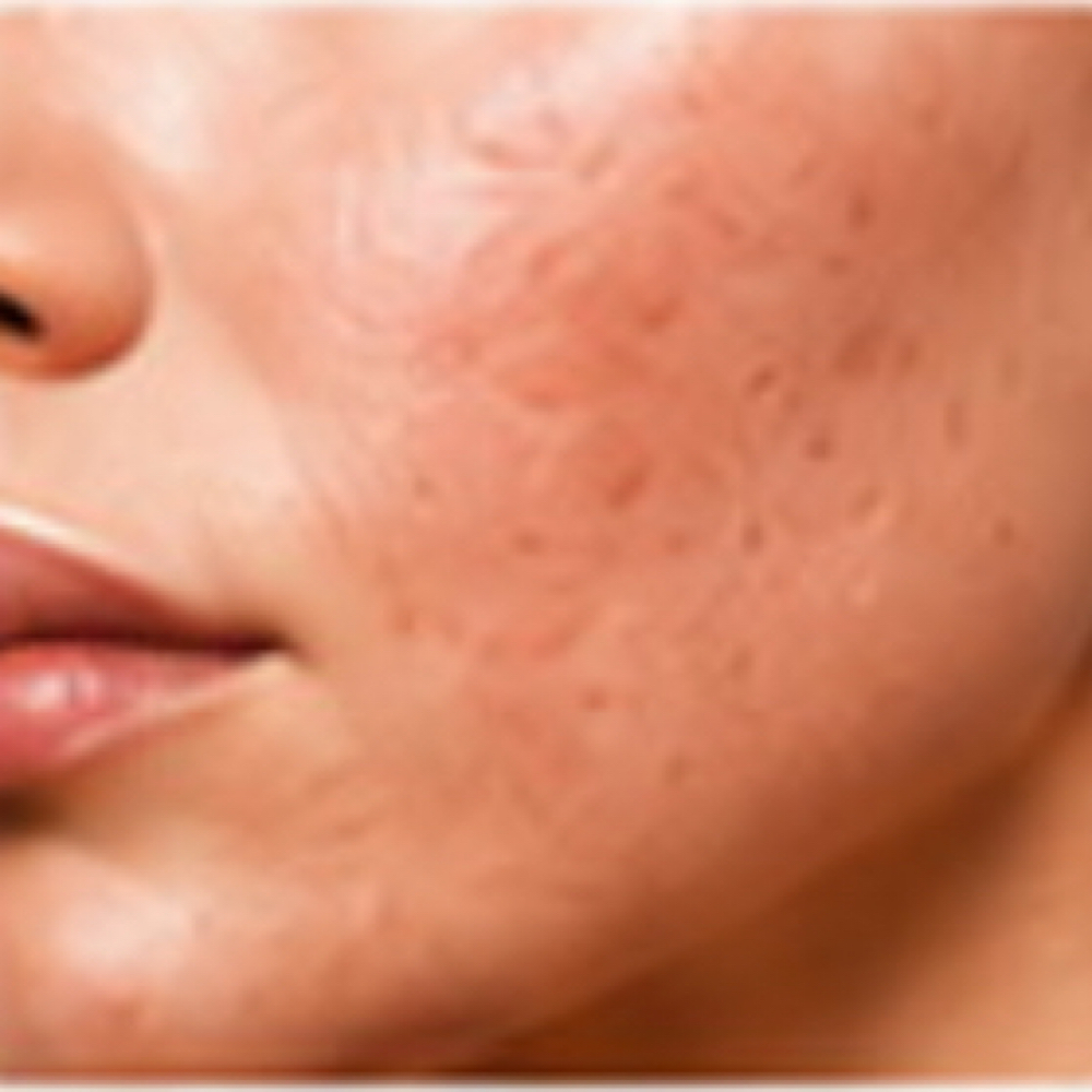 Acne Scar Revision at Plasmalift Skin Clinic LLC in Bettendorf, IA