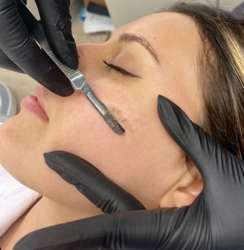 Dermaplane Facial