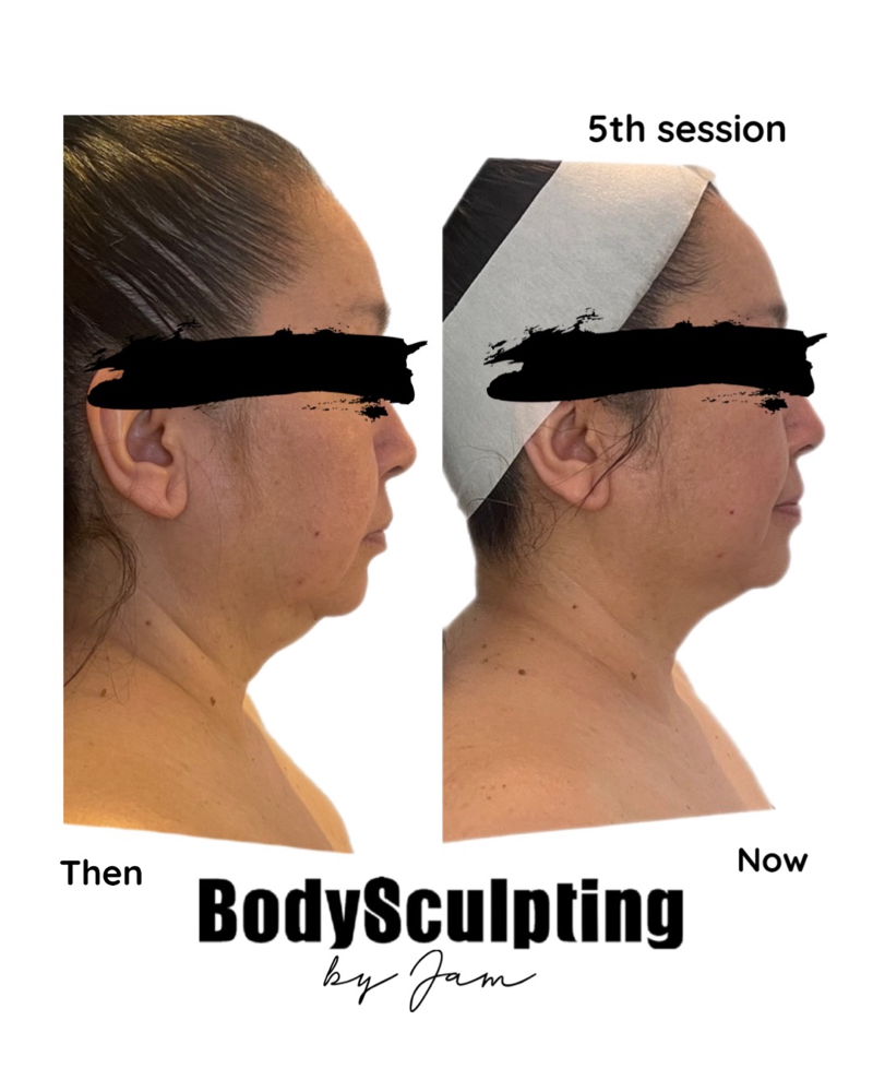 RF Lift Facial at Beauty & Esthetics By Jam in Henderson, NV