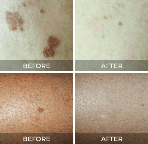 Skin Tag/Sun Spot Removal