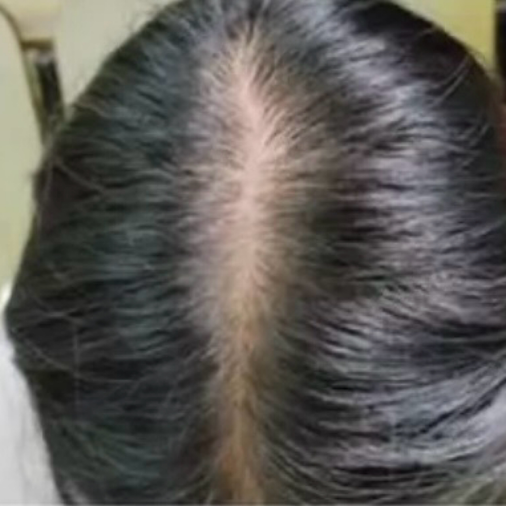 Exosomes Hair Loss at Josephs Rejuvenation Center in Snellville, GA