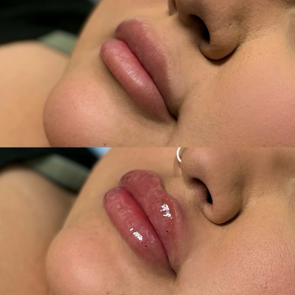 Hyaluron Pen Filler at Beauty Studio by J in Albuquerque, NM