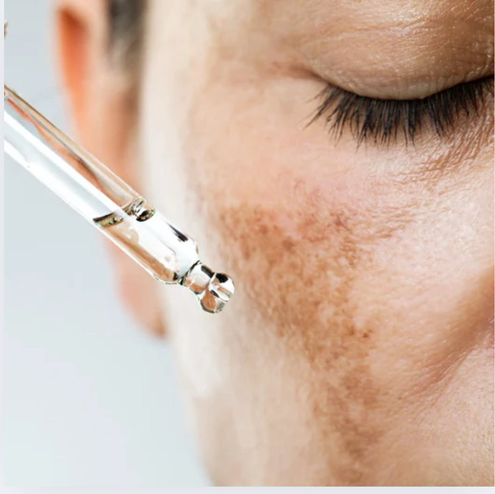 Hyperpigmentation Skin Solution