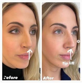 Non-Surgical Rhinoplasty