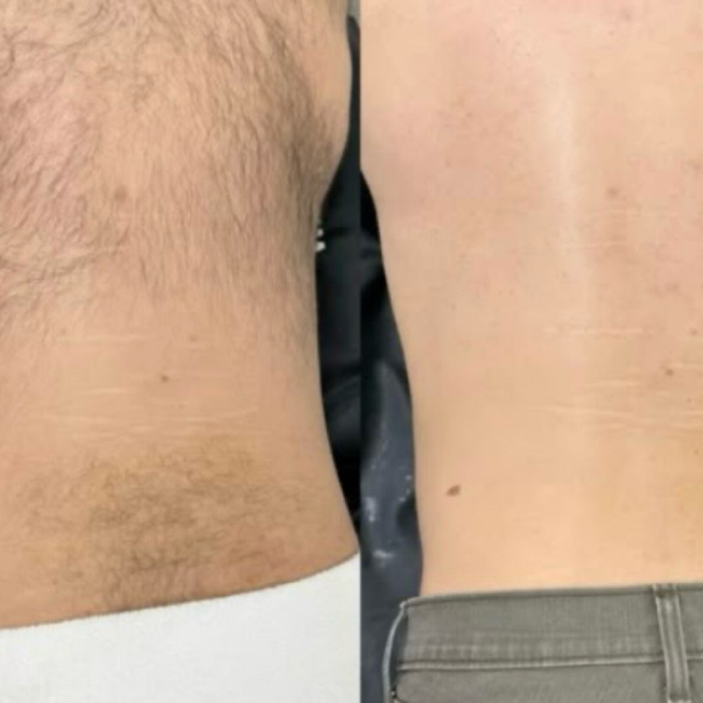 Back wax at Nouvèl Beauty Collective in New London, CT