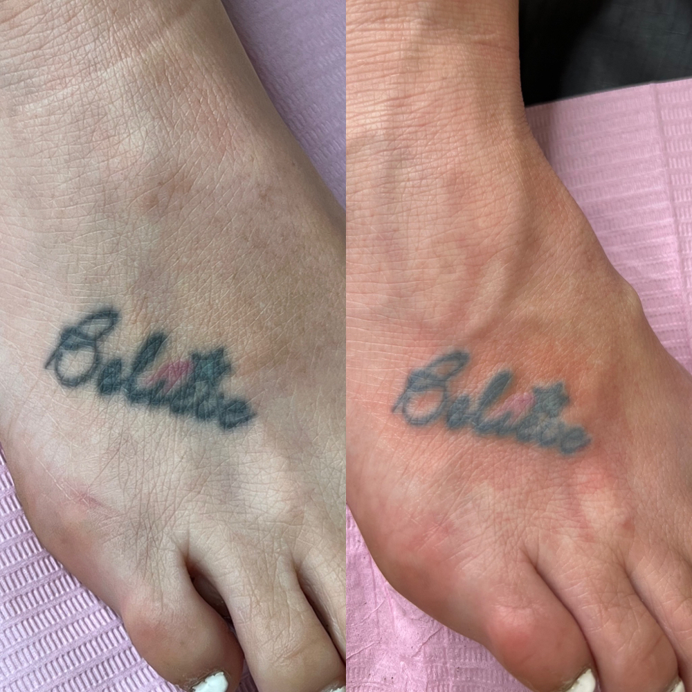 Saline Tattoo Removal