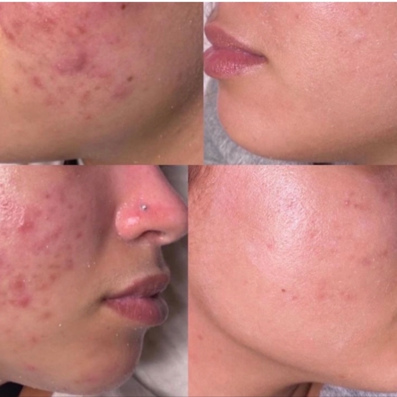LEVEL 2 CHEMICAL PEELS- See Details at MUSE MAVEN SKINTIQUE AND WELLNESS in Atlanta, GA