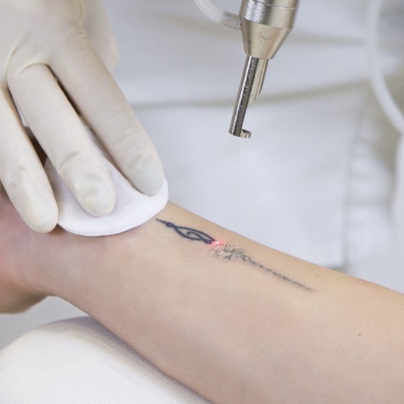 TATTOO LASER REMOVAL