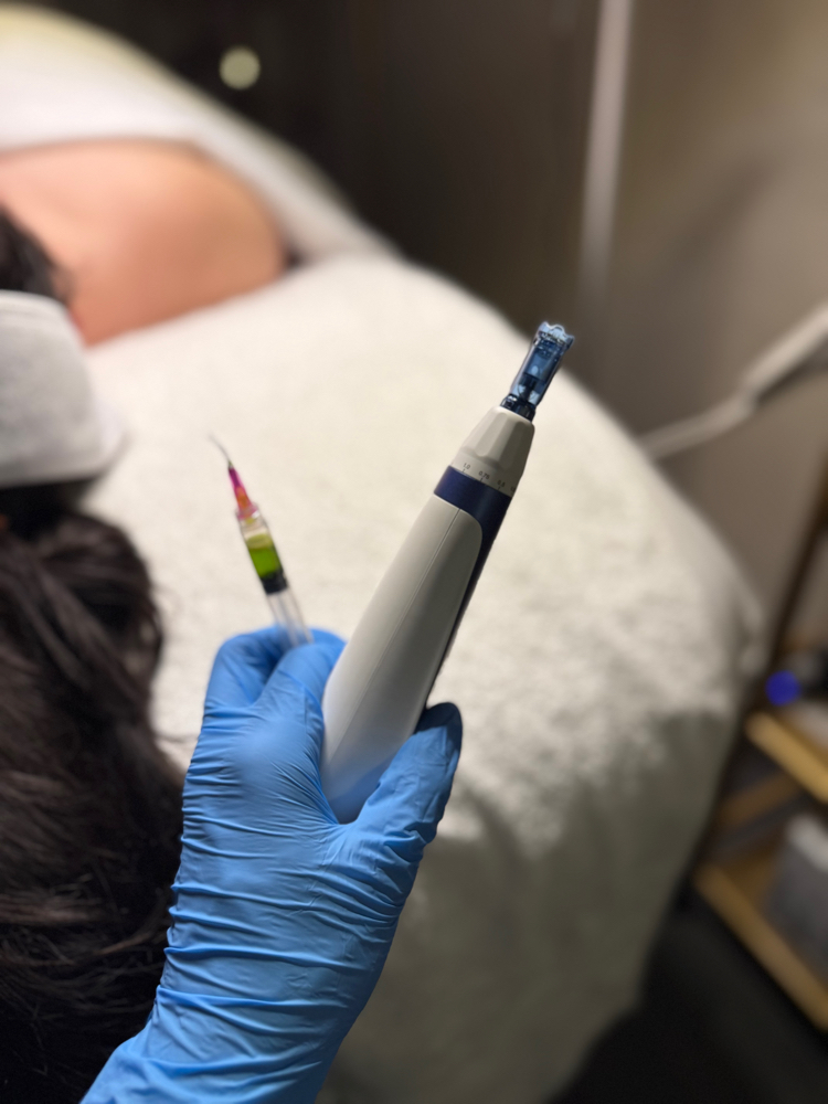 Microneedling with BioRePeel