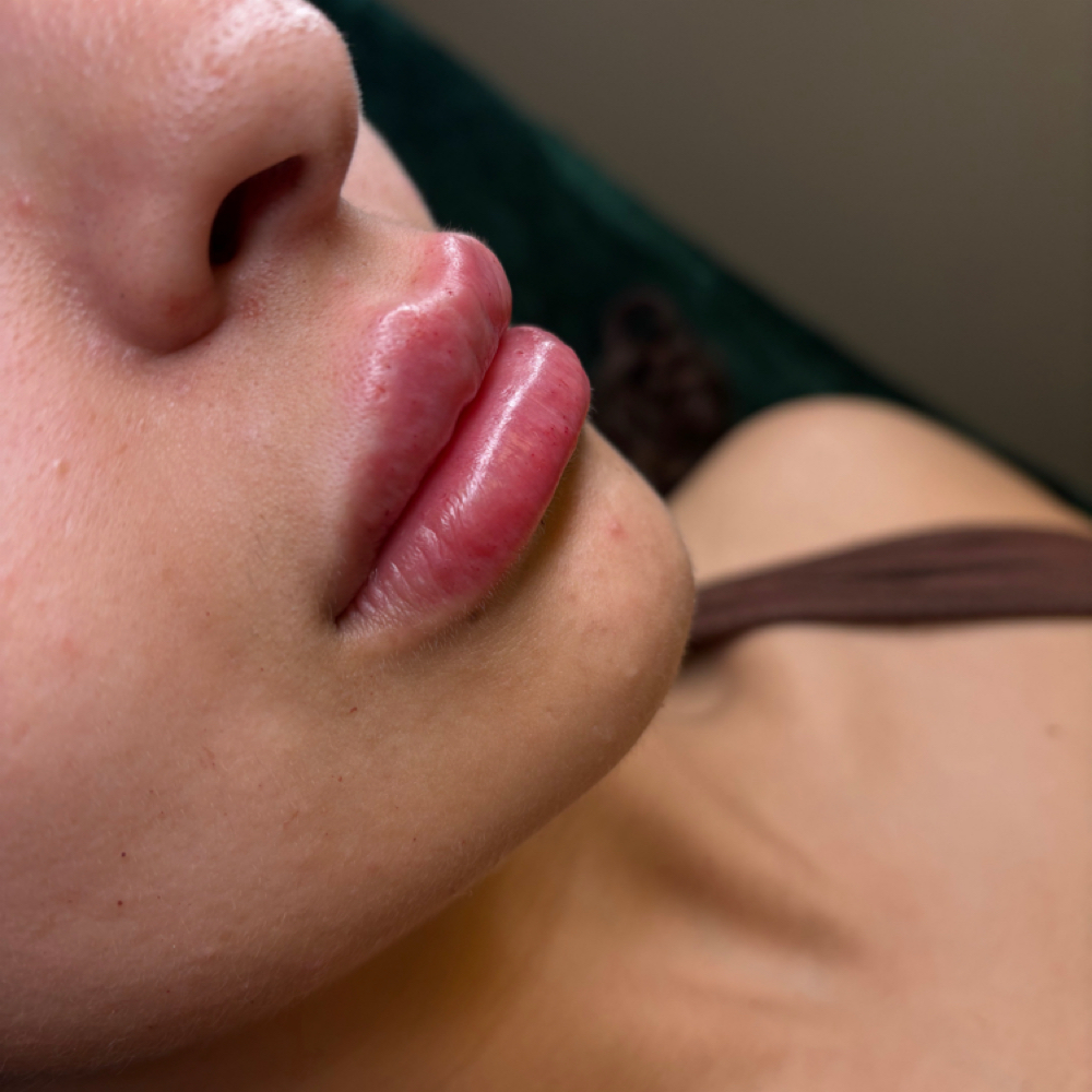 1.5ML at Unique’sbeautybar in Oswego, IL